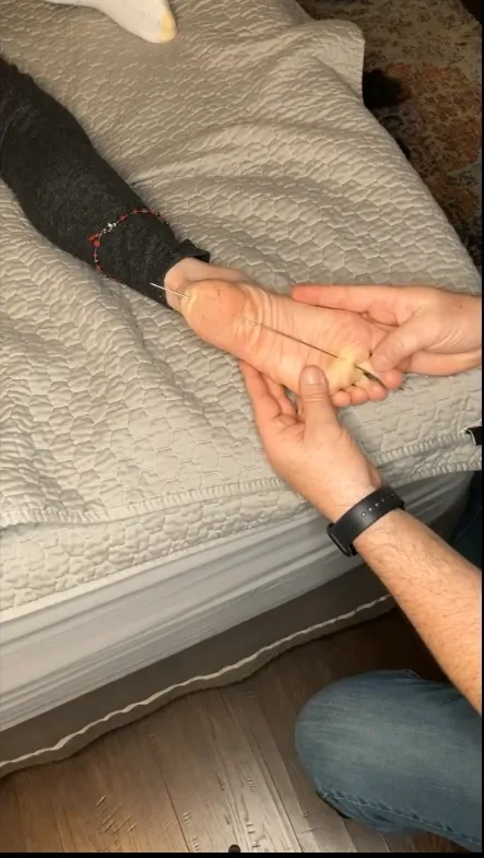 (女脚)穿刺电钻 (女脚)穿刺电钻
