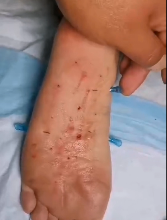 (重口)小护士足刑下集,书钉穿刺注射针灸 (重口)小护士足刑下集,书钉穿刺注射针灸
